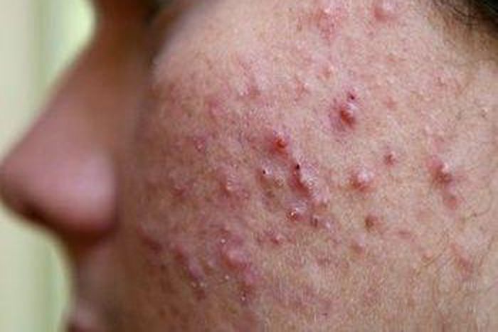 ___4107028___https:______static.pulse.com.gh___webservice___escenic___binary___4107028___2015___8___26___15___sattvik-organics-acne-treatment-kit-reviews-isotretinoin-get-does-rid-scars-ma8