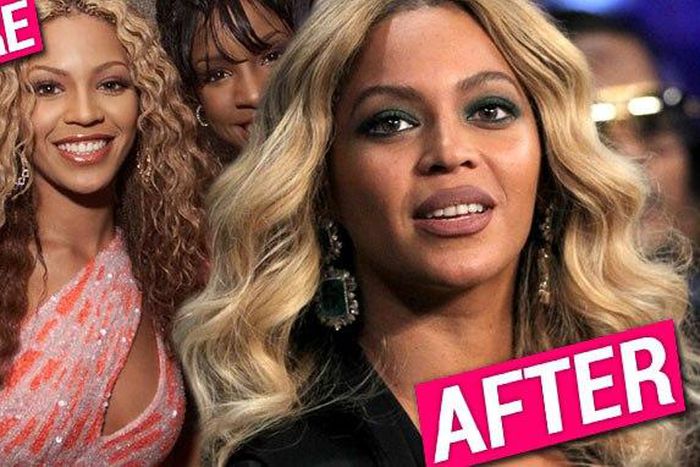 Has Beyonce done surgery on her face?