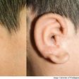 An under-developed ear replaced with a 3D printed ear