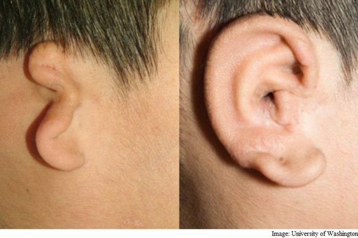An under-developed ear replaced with a 3D printed ear