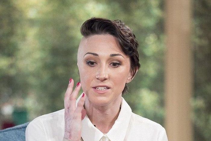 A beautician was disfigured in an acid attack orchestrated by her jealous ex-boyfriend.