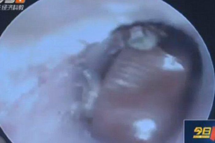 Cockroach gives birth to 25 babies in man's ear