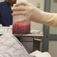 This amount of blood had to be extracted from his penis to relieve him.