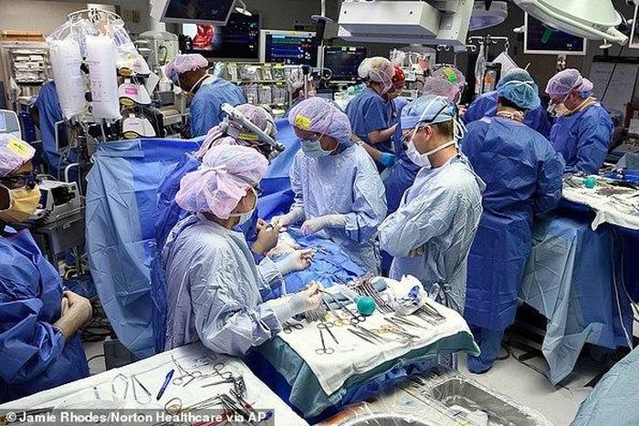 7-weeks old Conjoined twins who shared a heart separated successfully