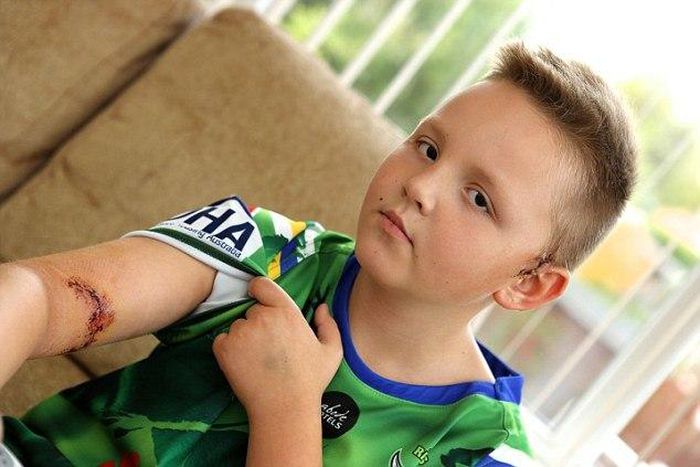 A 9-year-old boy needs plastic surgery after a neighbour's dog bit him on his arm.