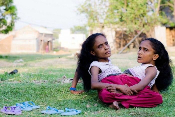 After 46 years of looking for love conjoined twins Ganga and Jamuna Mondal popularly known as 'The Spider Sisters' have finally found love with the same man.
