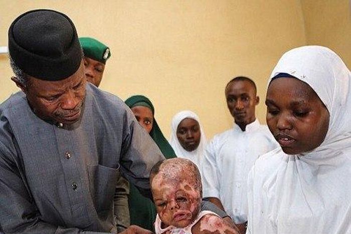Vice President, Yemi Osinbajo with a child injured in a Boko Haram attack.