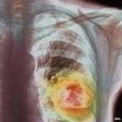 ___3818265___https:______static.pulse.com.gh___webservice___escenic___binary___3818265___2015___6___1___19____83308741_m1340336-coloured_x-ray_showing_lung_cancer-spl