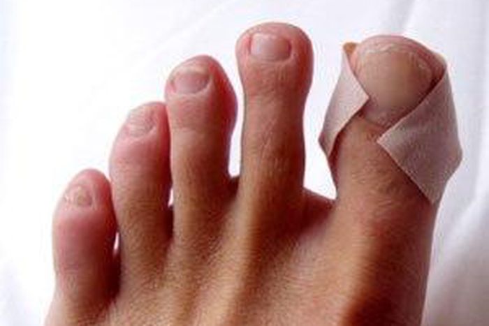 Runners blisters