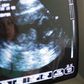 Top court rejects North Carolina abortion ultrasound case