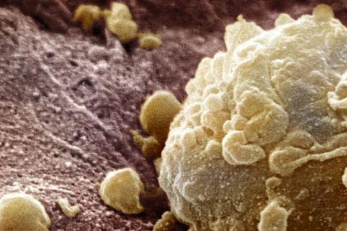 ___3819584___https:______static.pulse.com.gh___webservice___escenic___binary___3819584___2015___6___2___11____83335825_cancercell