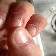 Damaged fingernails