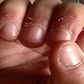 Damaged fingernails
