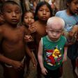 Albinos battle a bright foe