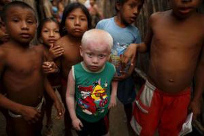 Albinos battle a bright foe