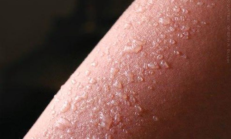 Sunburn blisters
