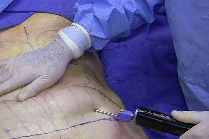 Side effects from weight loss surgeries