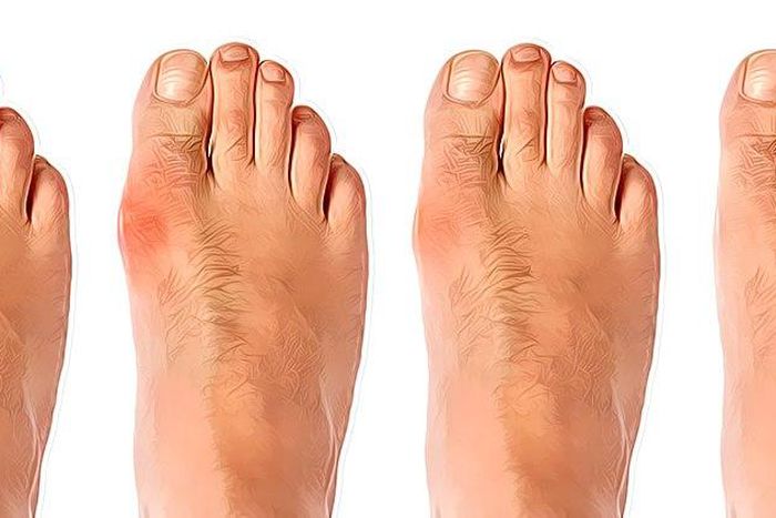 Bunion development, from mild to severe