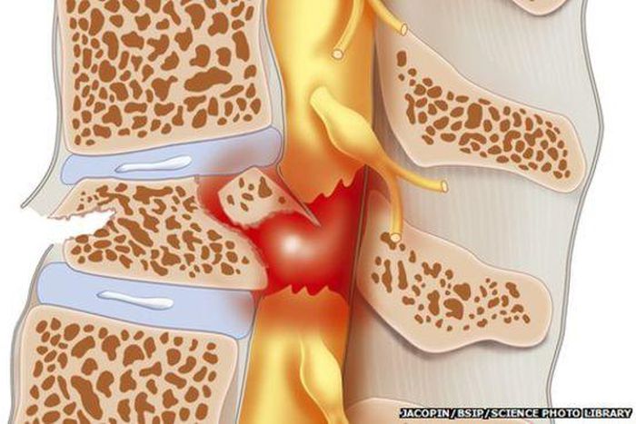 ___3818179___https:______static.pulse.com.gh___webservice___escenic___binary___3818179___2015___6___1___19____83296823_c0244205-spinal_cord_injury-spl