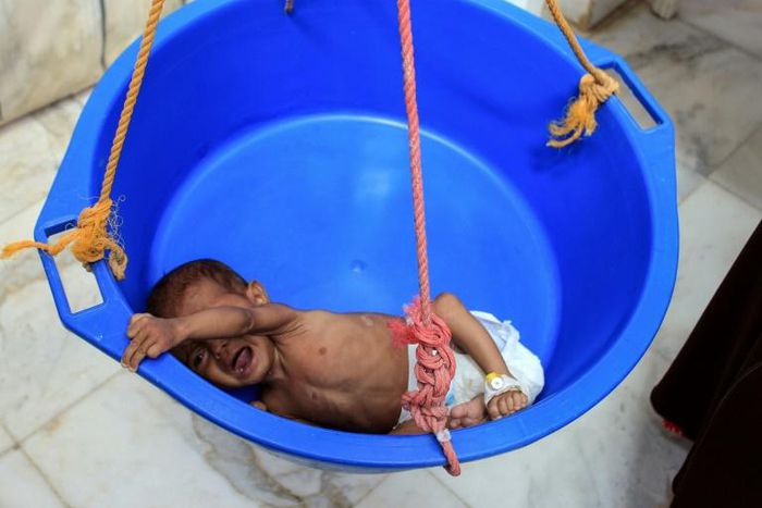 A Yemeni child suffering from severe malnutrition is weighed at a hospital in Yemen's northwestern Hajjah province