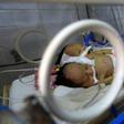 The twin boys shared a kidney and a pair of legs but had separate hearts and lungs