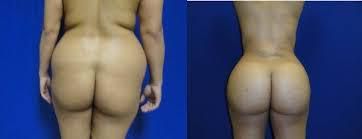 The effects of BBL surgery when done correctly in order to achieve the desired hourglass shape