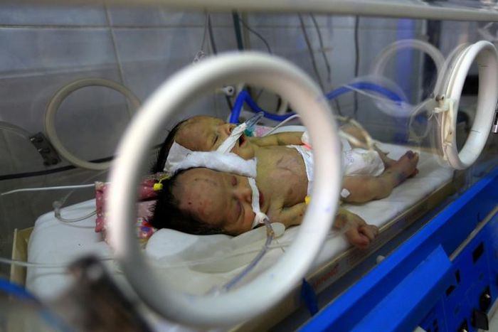 Hospitals in Yemen's blockaded rebel-held capital lack the facilities to provide specialist care for Abdelkhaleq and Abdelkarim, conjoined twins who were born outside Sanaa around 10 days ago