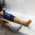 A boy receives treatment for leishmaniasis at the Bir Al-Ostah Milad Hospital for Dermatology in the Libyan capital, Tripoli on February 11, 2019