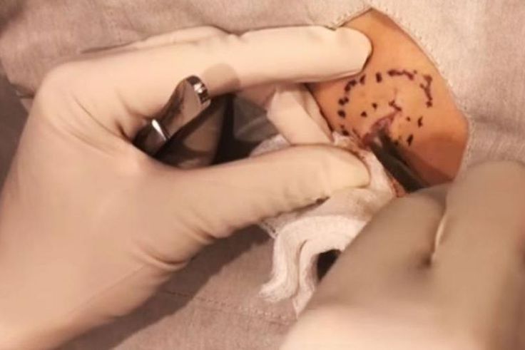 Dr. Pimple Popper's Latest Video Is Truly Vile
