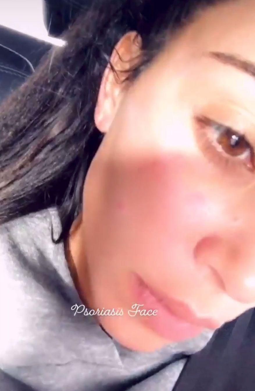Kim Kardashian Shared No-Makeup Psoriasis Selfie