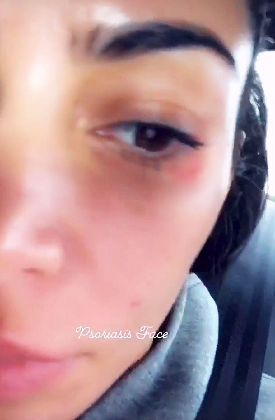 Kim Kardashian Shared No-Makeup Psoriasis Selfie