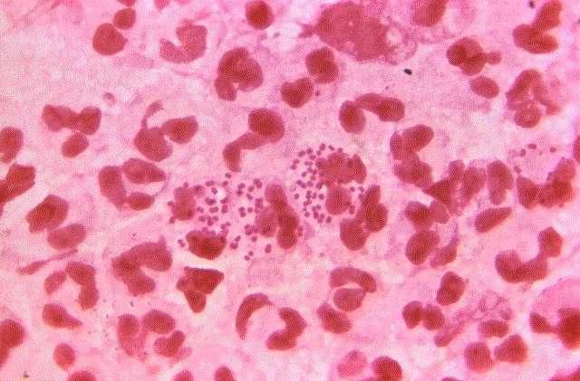 A new super strain of gonorrhea may soon become untreatable [Credit: Medical Xpress]