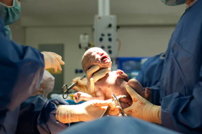 A baby delivered through Caesarean section  [ndanitv]
