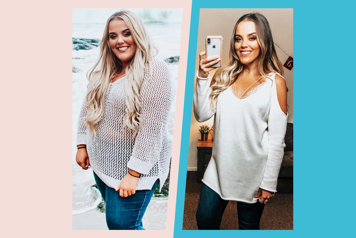 'I Lost 150 Pounds After Gastric Bypass'