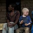 Malawi, one of the world's poorest countries, has experienced a spike in violent attacks on people with albinism. In many cases those with albinism are targeted for their body parts to be used in witchcraft