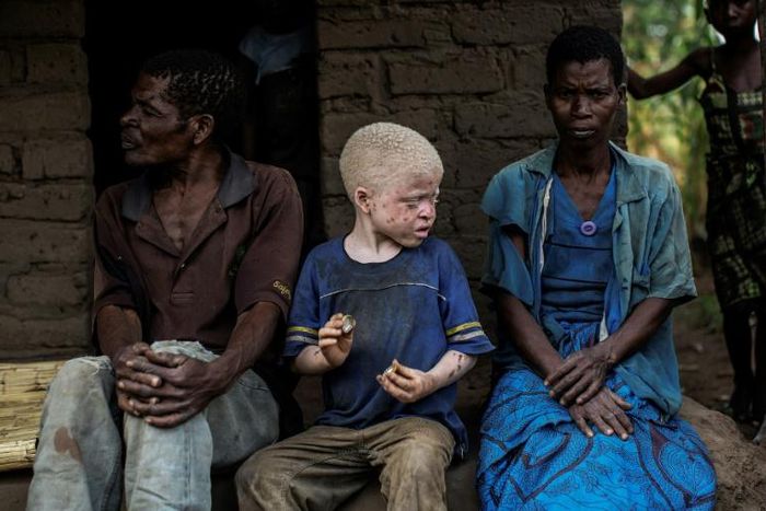 Malawi is seeing a surge in attacks on people with albinism -- many have been targeted for their body parts, for use in witchcraft