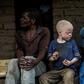 Malawi is seeing a surge in attacks on people with albinism -- many have been targeted for their body parts, for use in witchcraft