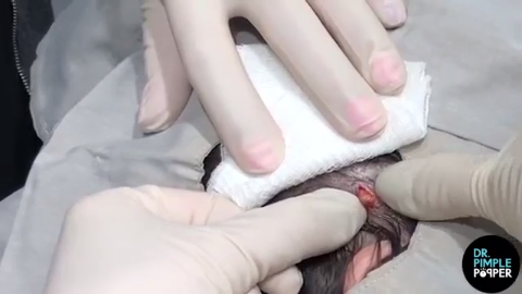 Dr. Pimple Popper Removes 'Orange Seed' Pilar Cyst