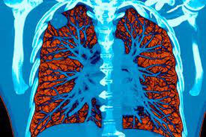 AI took a test to detect lung cancer, it got an A