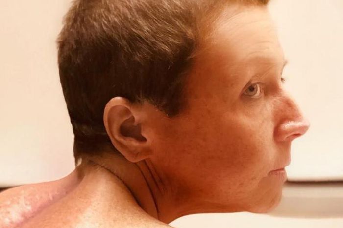 Abby Lee Miller Shares Photo Of Spinal Scar