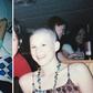 I Was Diagnosed With Ovarian Cancer When I Was 17