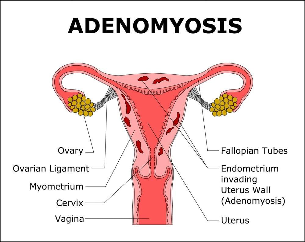 Adenomyosis is when tissue that lines the uterus is present inside the muscular wall of the uterus [Credit: Faculty of Medicine- University of Queensland]