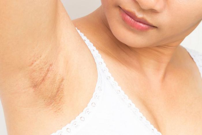 Dr. Pimple Popper Pops Armpit Cyst In New Video