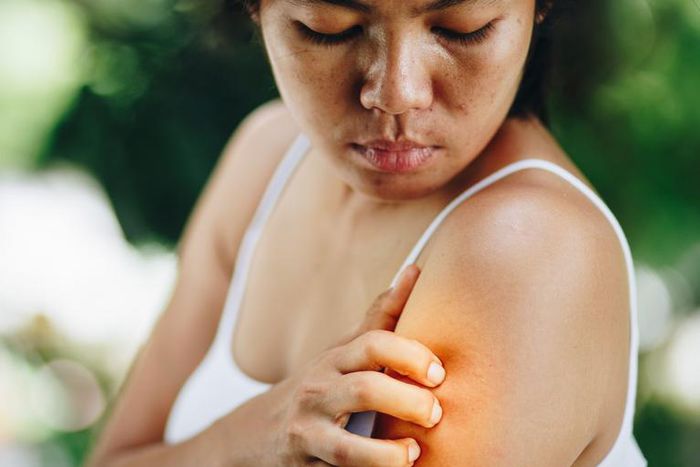 6 Types Of Bug Bites You Never Want To Ignore