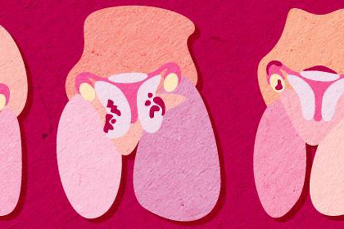 As Nse Ikpe-Etim opens up about her struggles, here's all you need to know about adenomyosis [Credit: Endometriosis.net]