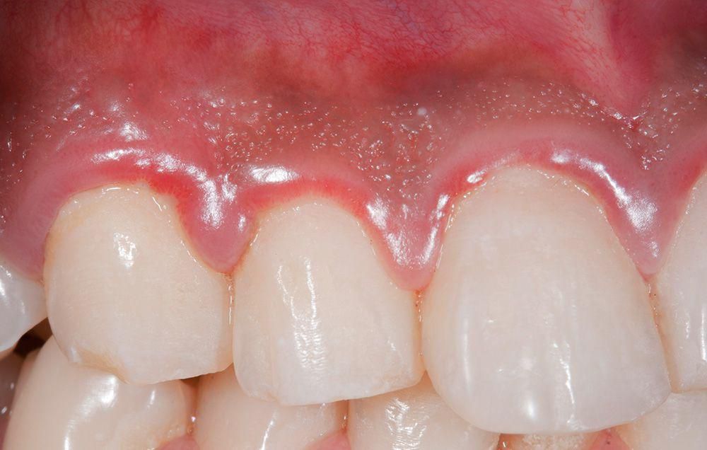 erectile dysfunction signs