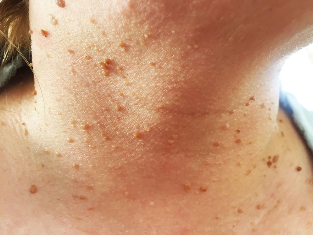 12 Bumps On Your Skin That You Should NEVER Pop