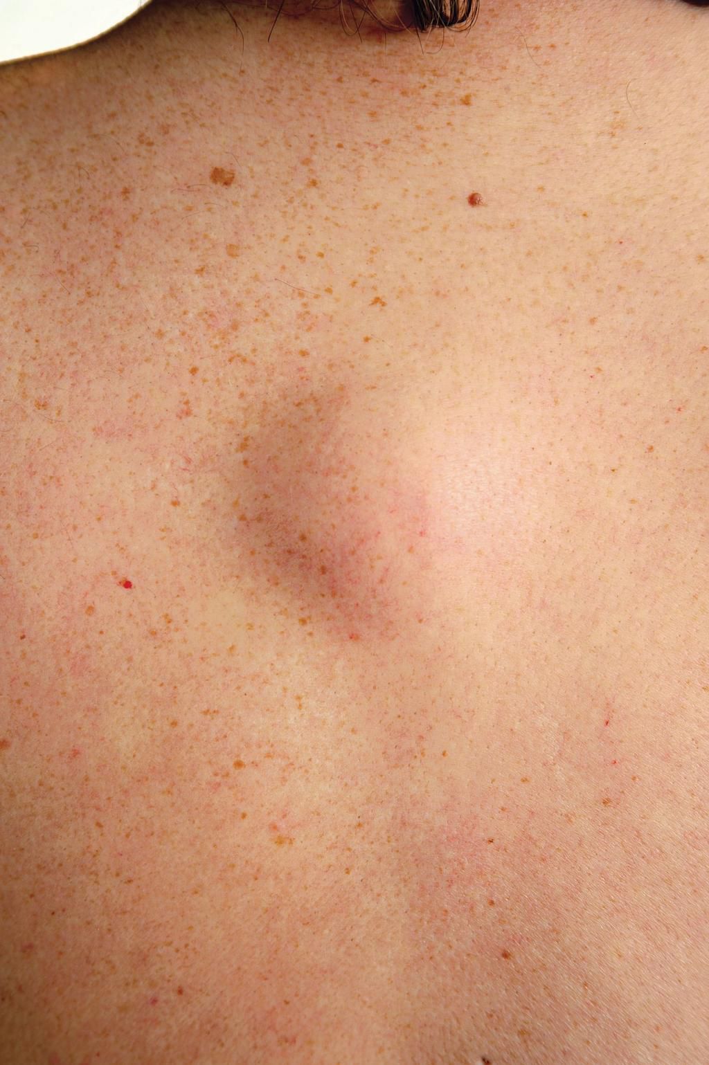 Lipoma on woman's back
