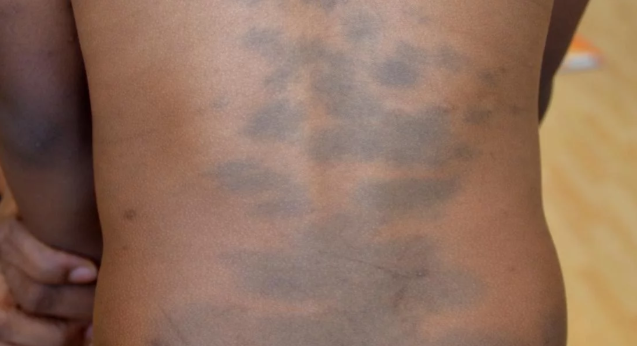 Mongolian spot. Source: Medical News Today
