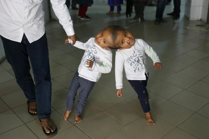 The twins, named Rabeya and Rukaya, had their skulls and brains successfully separated in a marathon 30-hour operation carried out by Hungarian surgeons